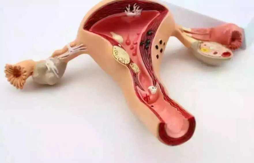 带你认知子宫肌瘤