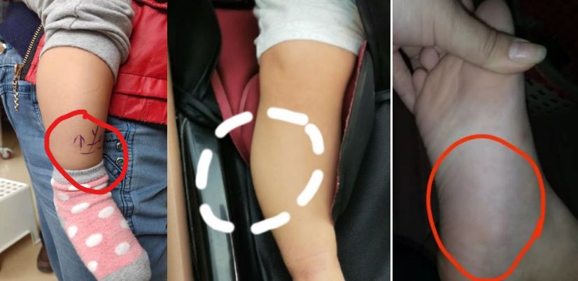 小儿童眼肿瘤,孩子斗鸡眼眼球震颤