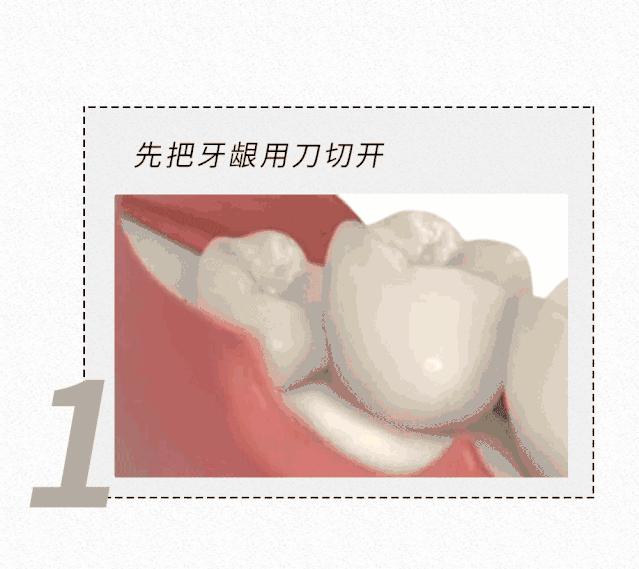 拔智齿的全过程漫画,智齿漫画版