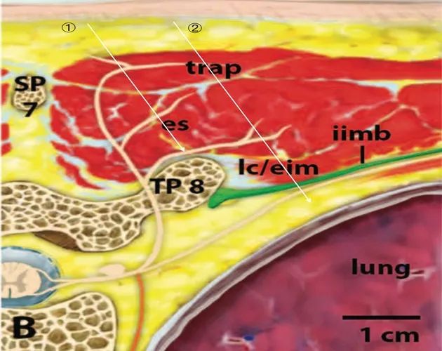 胸椎旁神经阻滞时需要穿过的韧带,胸椎旁神经阻滞超声探头位置