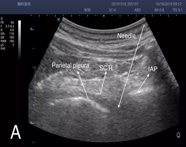 胸椎旁神经阻滞时需要穿过的韧带,胸椎旁神经阻滞超声探头位置