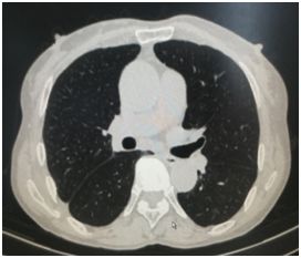 胸腔积液中医诊断是什么,胸外科微创治疗胸腔积液