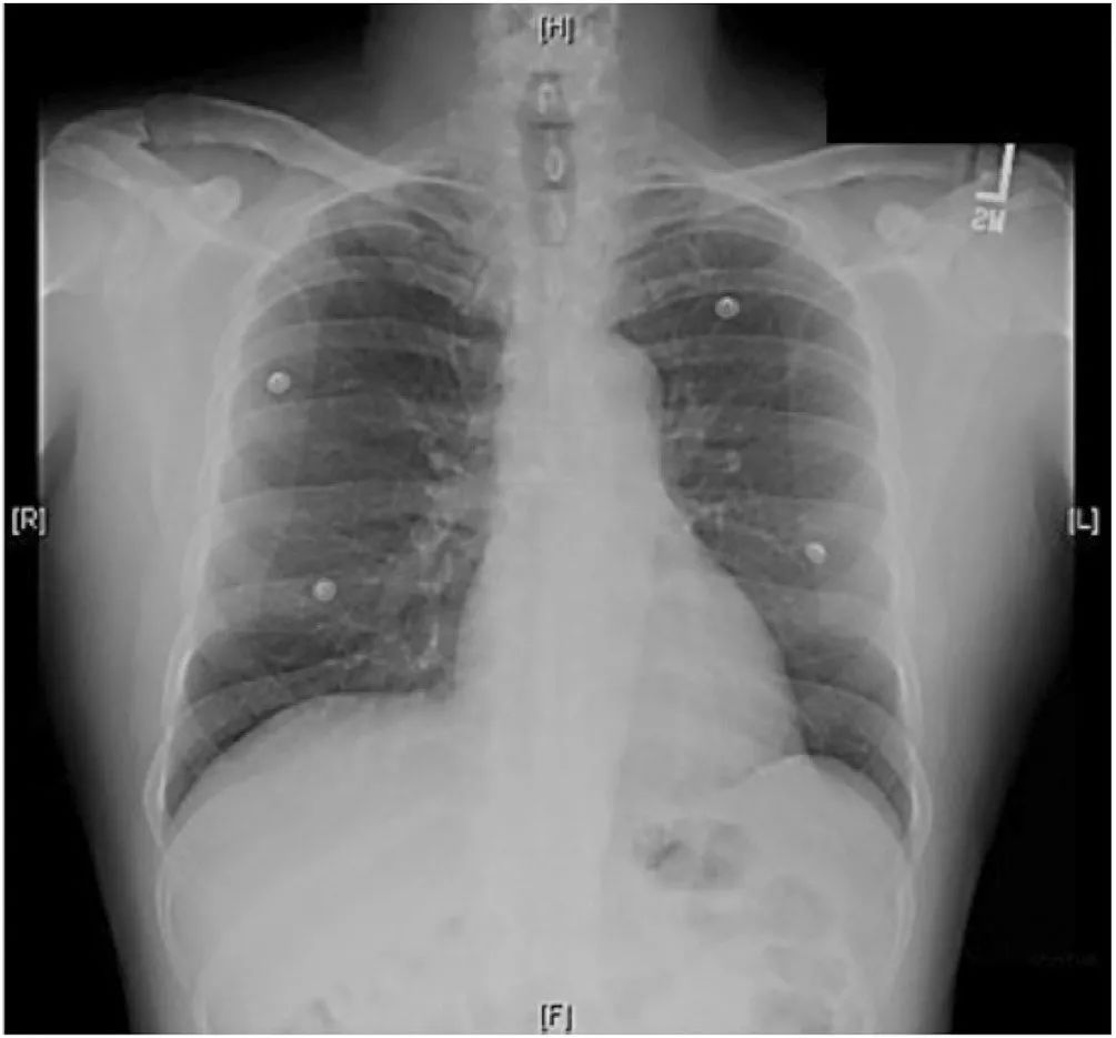 高血压急症的治疗,高血压急症个案