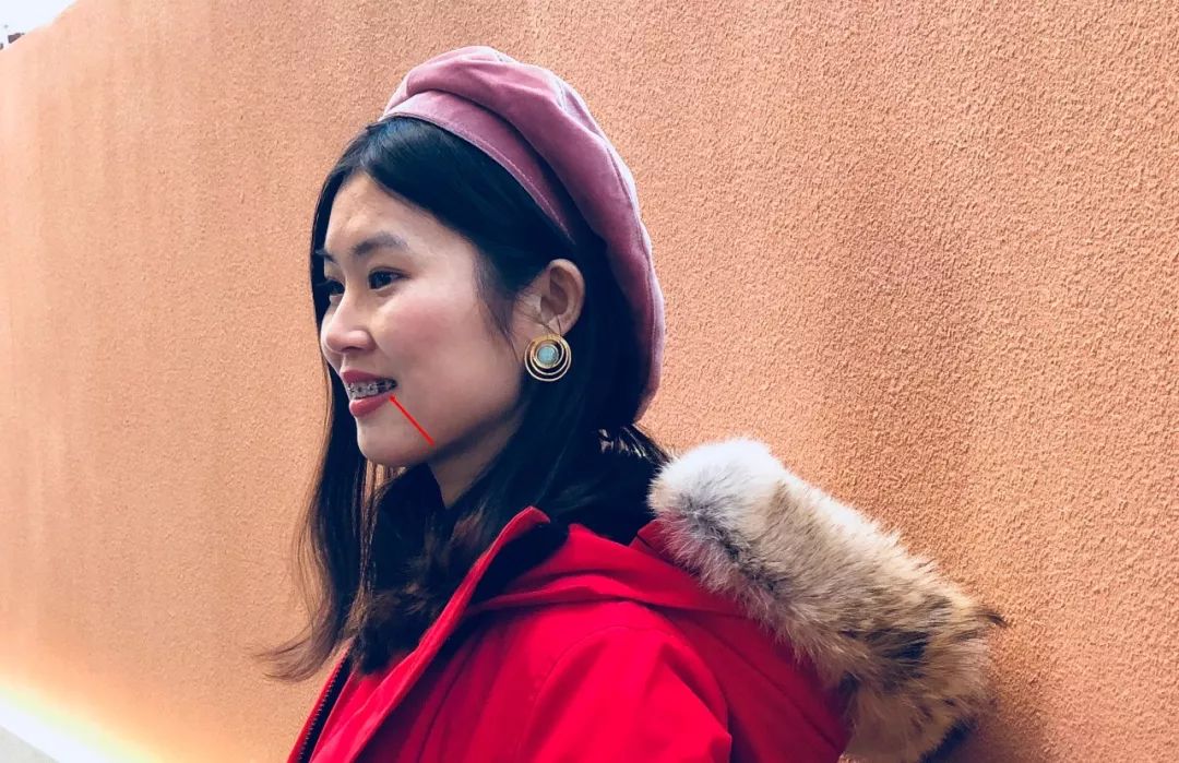 摘掉牙套后颜值会提高吗,戴完牙套颜值飙升