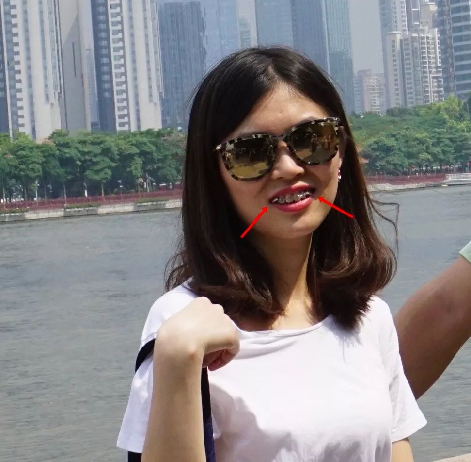 摘掉牙套后颜值会提高吗,戴完牙套颜值飙升