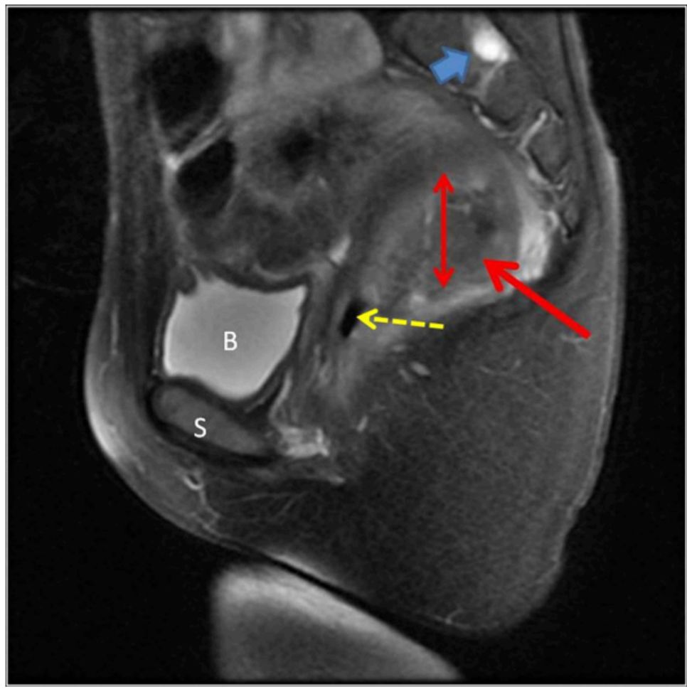 肠重复畸形严重吗,宝宝肠重复畸形怎么治疗