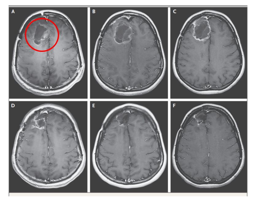 母髓细胞恶性脑瘤能治愈吗,恶性脑瘤有治愈的吗