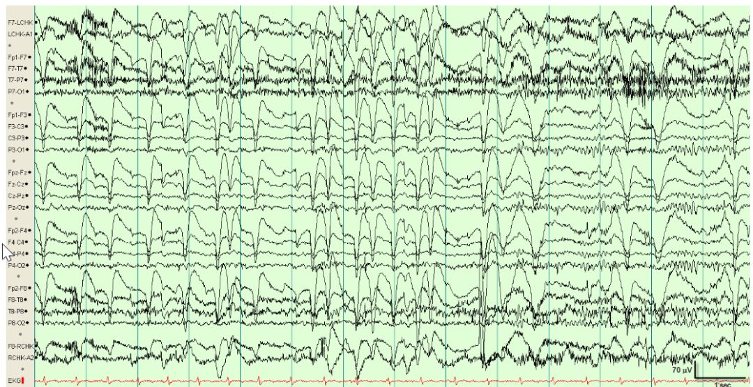 脑电图伪差图,脑电图伪差图谱