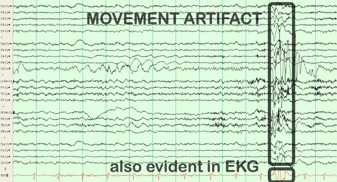 脑电图伪差图,脑电图伪差图谱