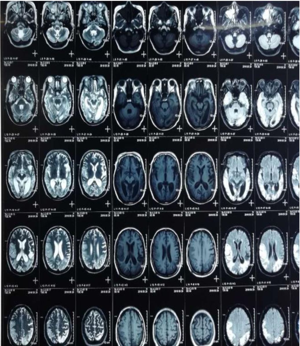 高氨血症有哪些表现,高氨血症