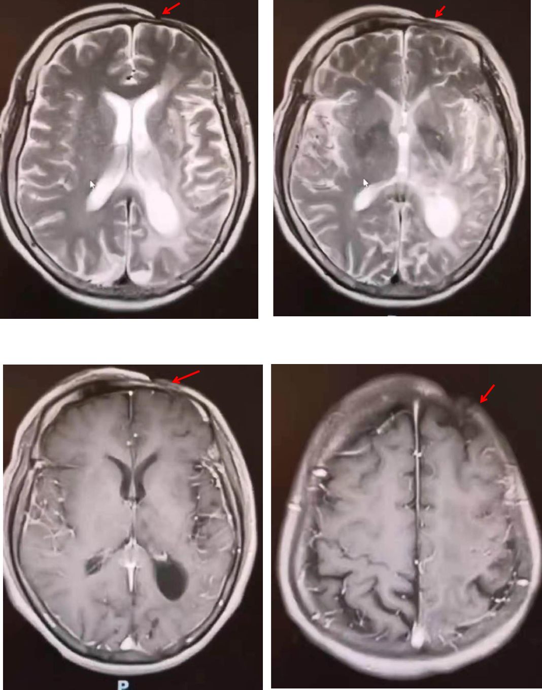 高氨血症有哪些表现,高氨血症