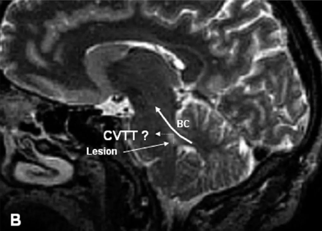 耳石症眩晕手法视频,耳石症头晕怎么训练
