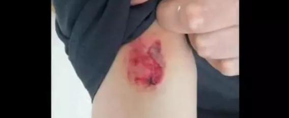 被艾滋病携带者咬了一口,该怎样处理?会不会被感染?