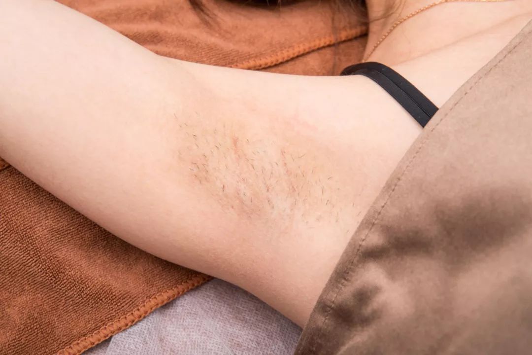 脱毛是不是秋冬季最适合,夏季脱毛便宜的方法有哪些