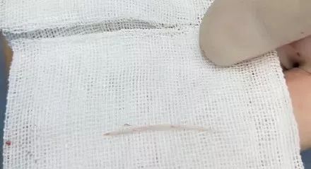 鱼刺卡住喉咙吞饭引危险,吃鱼吞了一根鱼刺开胸手术