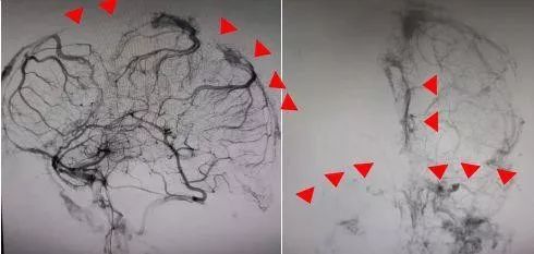 26岁小伙熬夜头晕,28岁小伙熬夜加班49小时