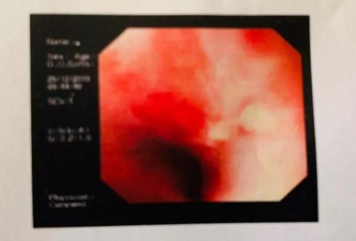 吃甲鱼肚子疼有什么危害,吃甲鱼肚子疼是中毒了吗