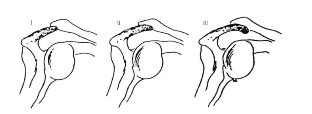 骨科科普|肩峰下撞击综合征
