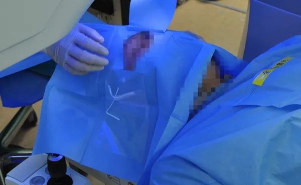 屈光手术与近视手术区别,屈光手术科普视频