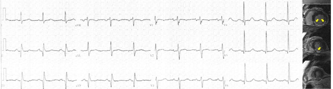 单纯心电图能判断心肌梗死吗,心电图判断冠心病准确吗