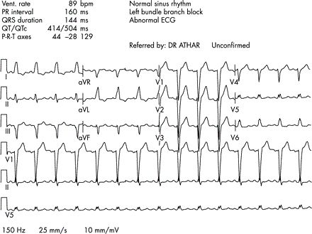 完全性左束支传导阻滞胸痛,左前分支传导阻滞胸痛