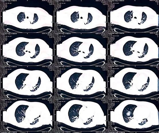 病例丨“一波三折”的三度房室传导阻滞，原因何在？