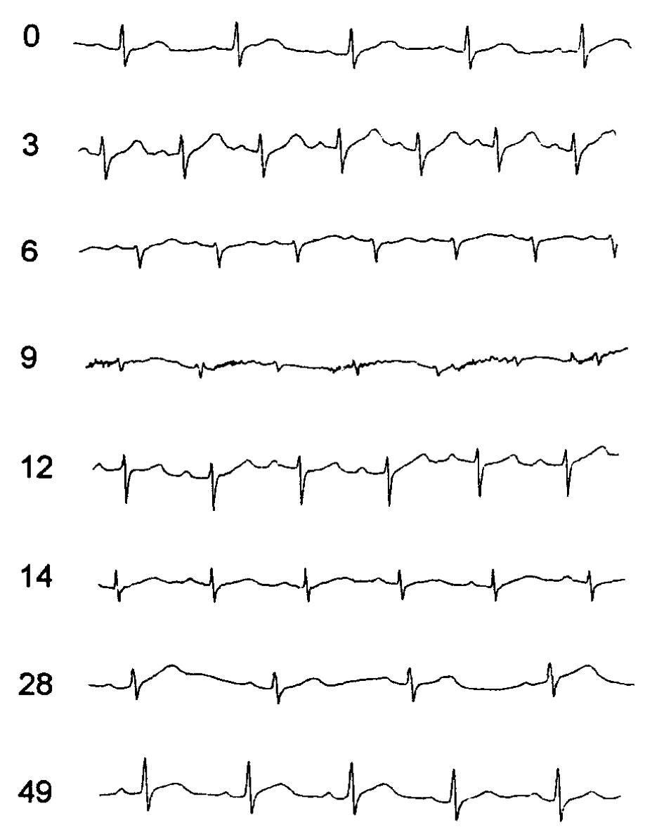 新型冠状病毒心电图,感染冠状病毒后会出现哪些症状
