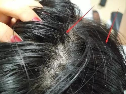 头上的螨虫用什么方法消除,头上又油又痒