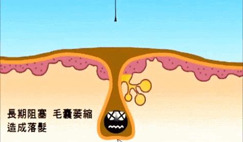 头上又油又有头皮屑又痒怎么办,头上又痒又油有头屑