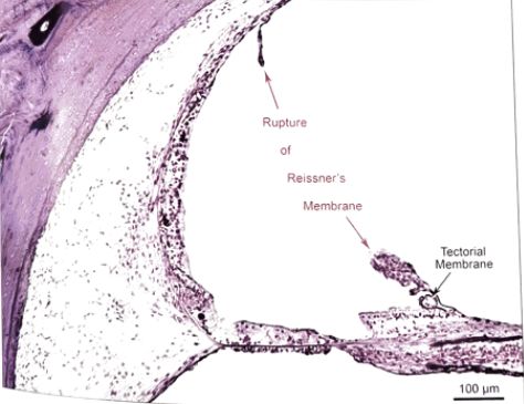 梅尼埃病深度解析,梅尼埃病病理解剖