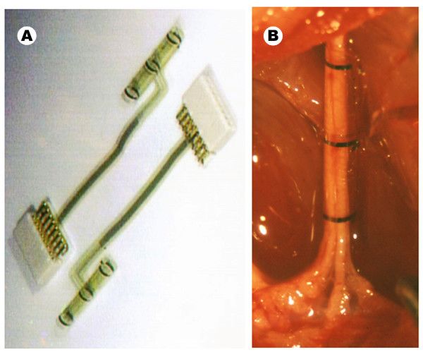 睡眠呼吸暂停的临床意义,肥胖睡眠呼吸暂停综合征