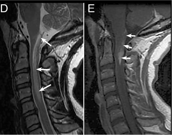 张星虎视神经脊髓炎,张星虎多发性硬化