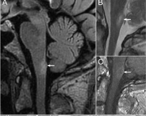张星虎视神经脊髓炎,张星虎多发性硬化