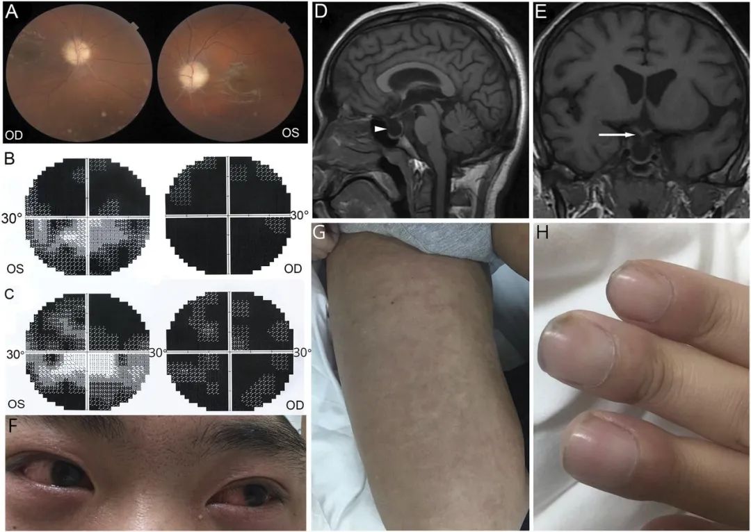 看似一例简单的慢性进行性视力障碍,背后的“黑手”竟然是.....丨临床推理