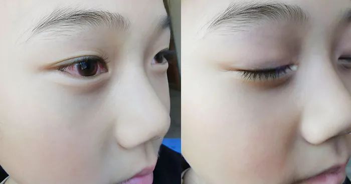 日本眼疲劳干涩护眼液,日本眼科蓝光过滤器