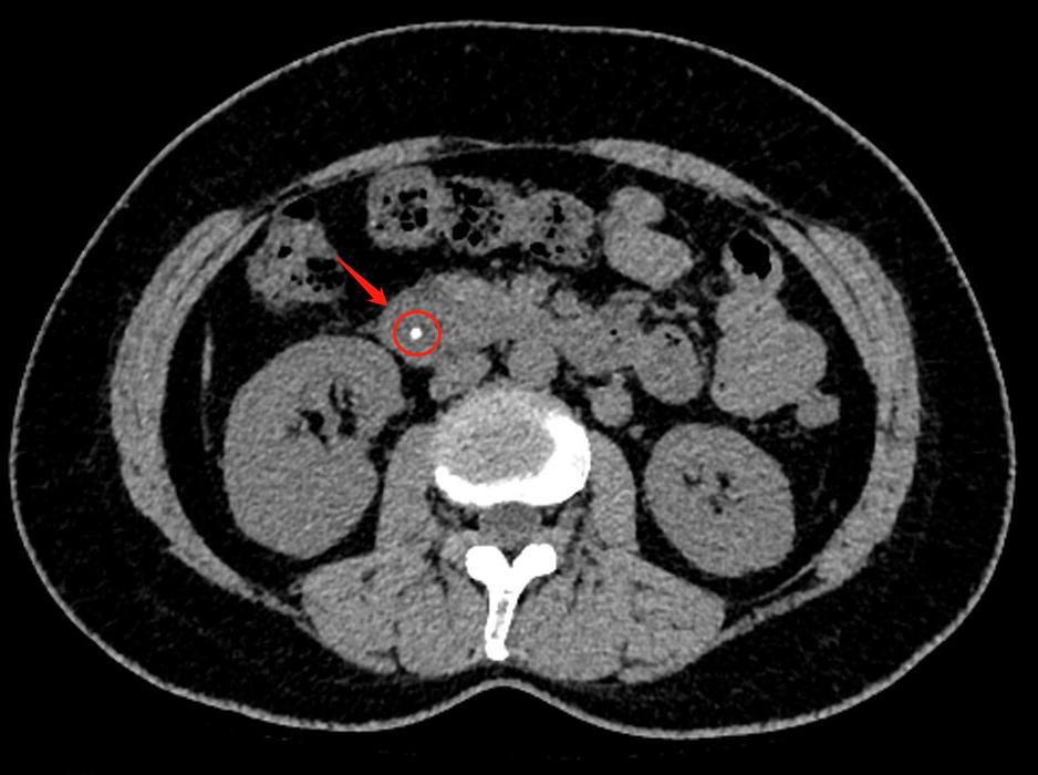 女人体内查出活虫只因一个菜,女子体内取出活虫只因爱吃