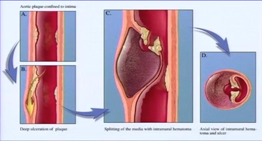 胸痛急救知识点,急性胸痛的诊断思路