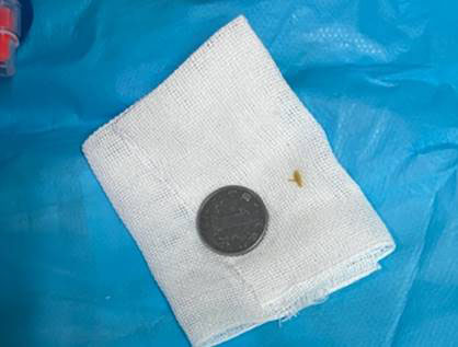 1岁小孩误吞硬币医生一秒取出,6岁孩子误吞硬币一周后才发现