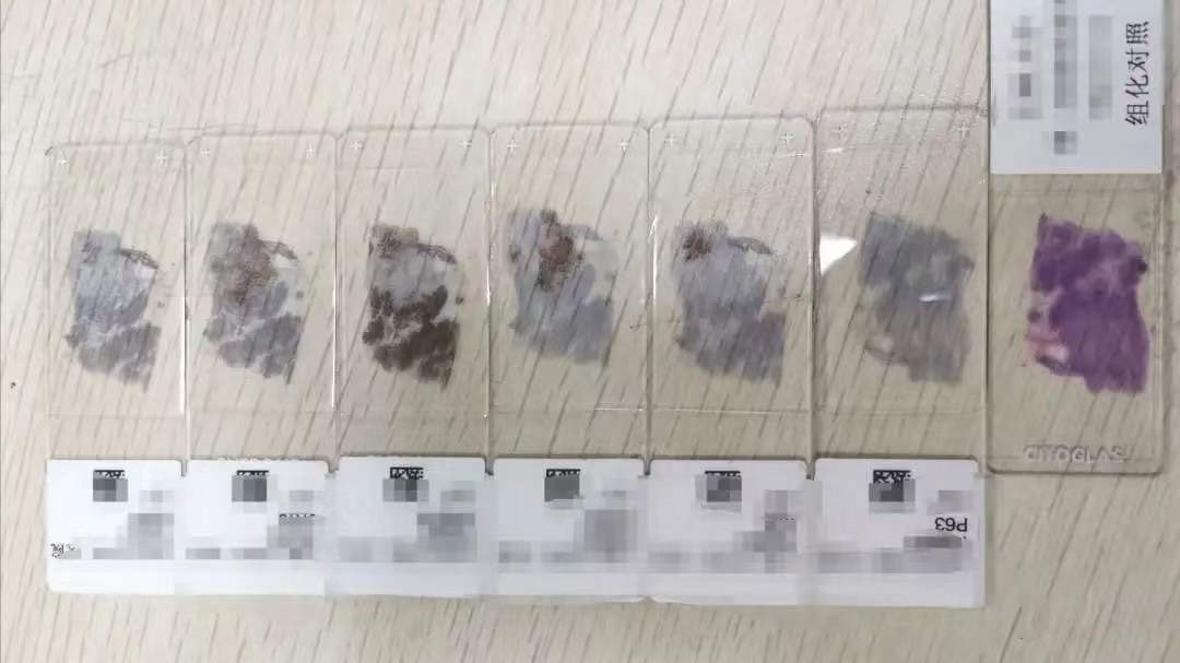 探秘病理科,病理科活检为什么慢