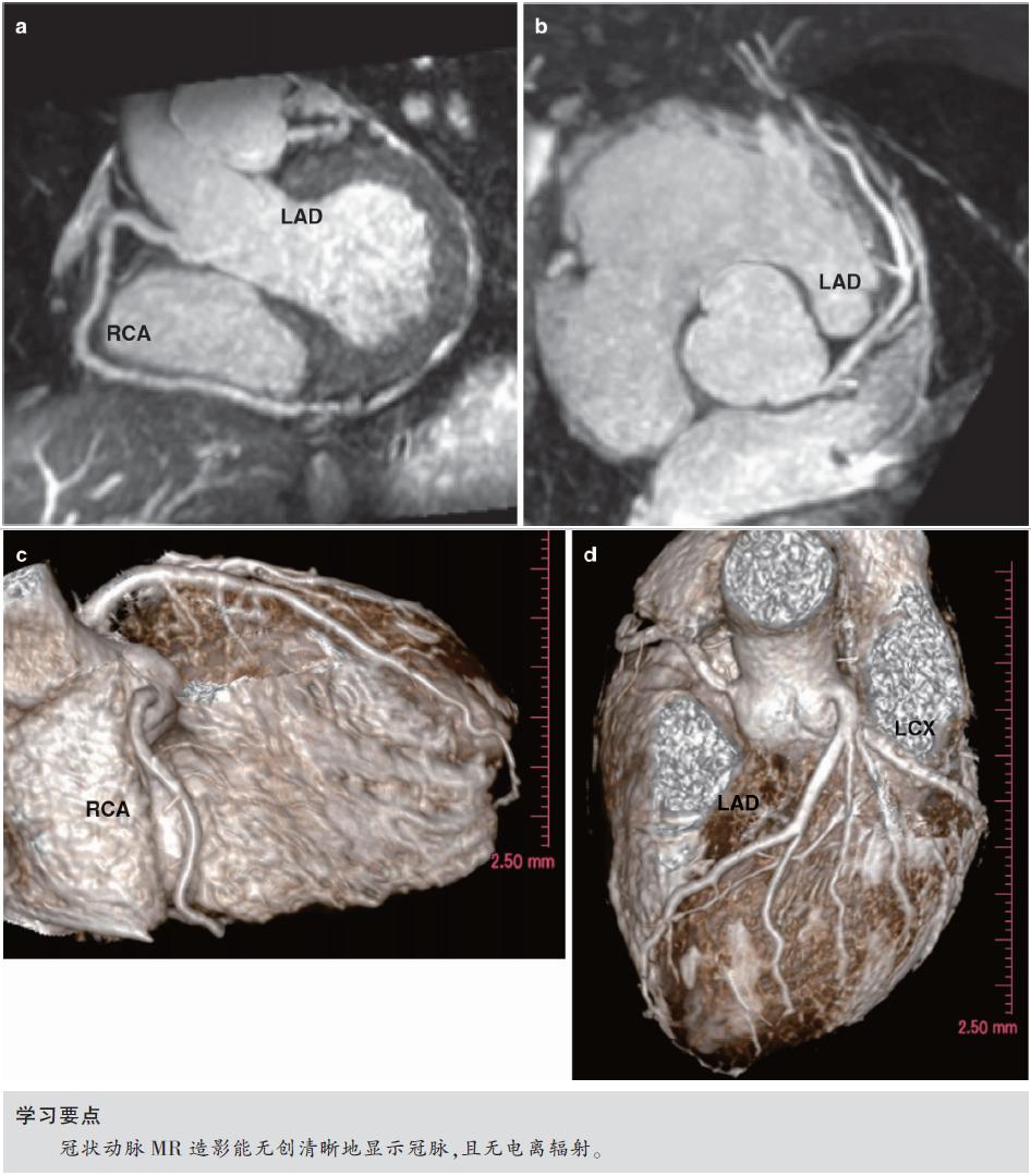 怎么看懂ct冠状动脉造影图片,冠状动脉造影图讲解