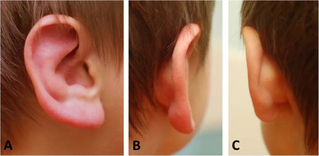 耳垂很红并发肿,耳朵上耳廓水肿图片