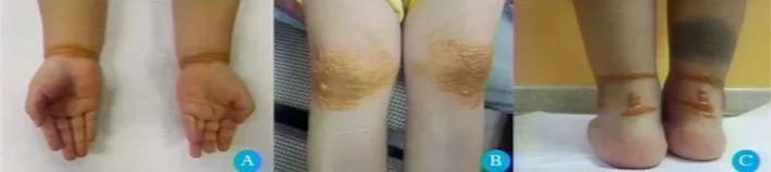 多发性黄色瘤,胆固醇高引起的黄色瘤是什么样的