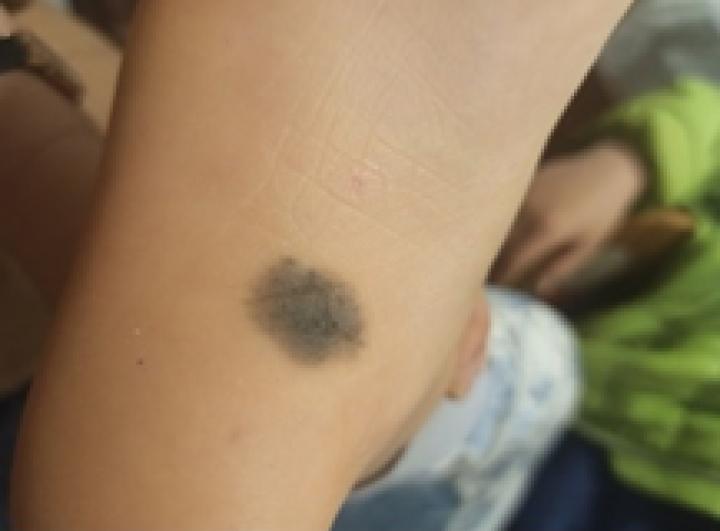 黑痣癌变的10个征兆,黑痣癌变从发病到去世不到两个月