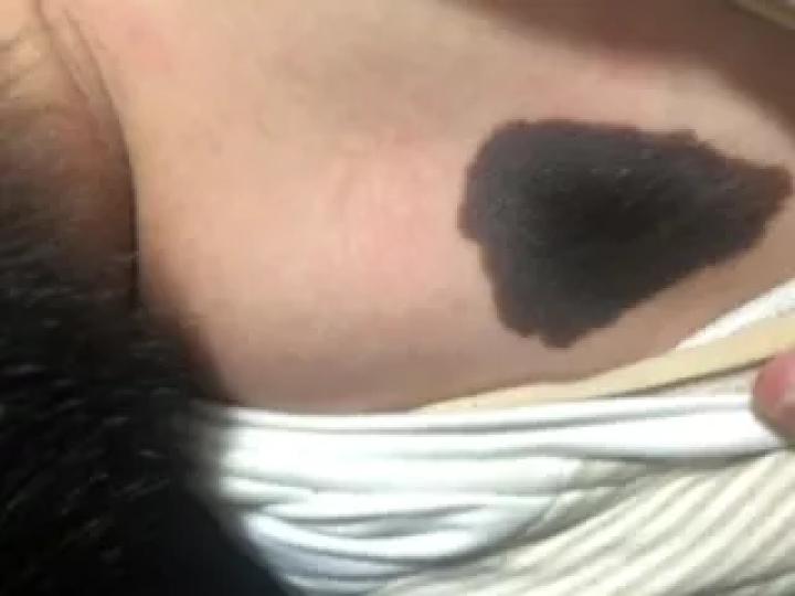 黑痣癌变的痣会很大吗,黑痣癌变一般是一个痣还是好多