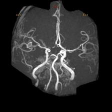 左侧大脑后动脉开窗畸形图片,脑部基底动脉开窗畸形如何治疗