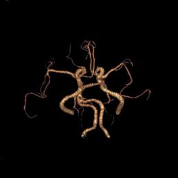 左侧大脑后动脉开窗畸形图片,脑部基底动脉开窗畸形如何治疗