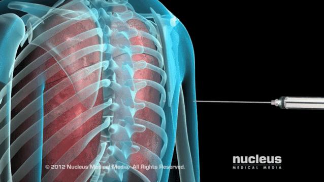 盘点医院各大科室侵入性检查：穿刺、内镜各显神通，小活检标本以“小”见“大”