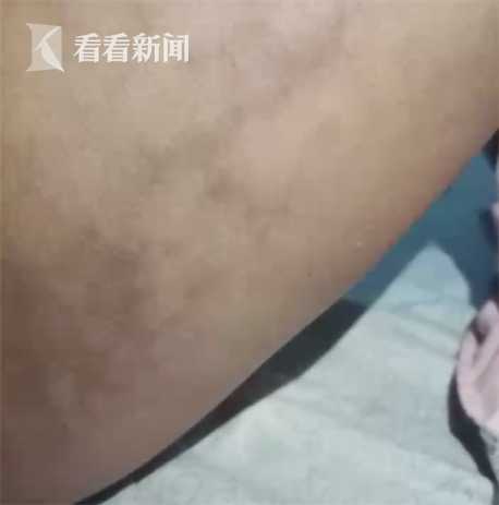 花6万块整容没想到整成这幅模样,脸太瘦整容