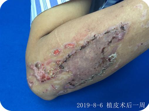 瘢痕体质留疤了怎么办,只有开刀才长疤是瘢痕体质吗