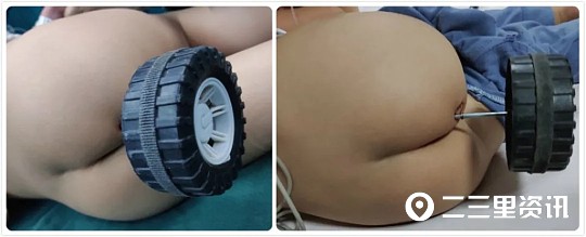 娃屁股上长了个疙瘩,宝宝屁股上长了个东西